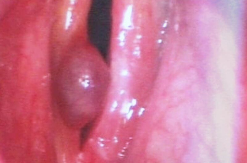 빨갛게-부어오른-성대