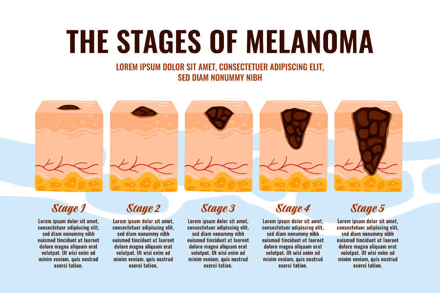 흑색종(Melania)이 처음 생겨서 점차 발전을 해서 악성이 되어 가는 5단계 과정을 이미지화 한 사진