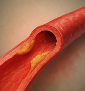 염증에 좋은 음식