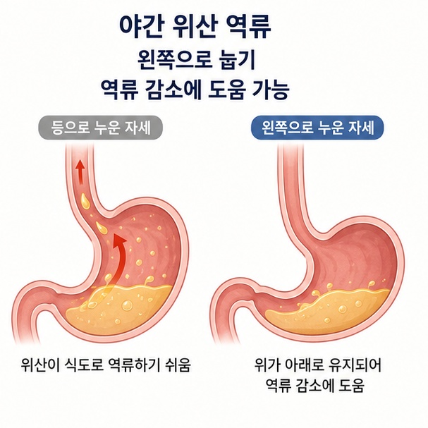 야간 위산 역류가 있을 때 왼쪽으로 누워 자는 자세가 도움이 될 수 있음을 설명한 이미지