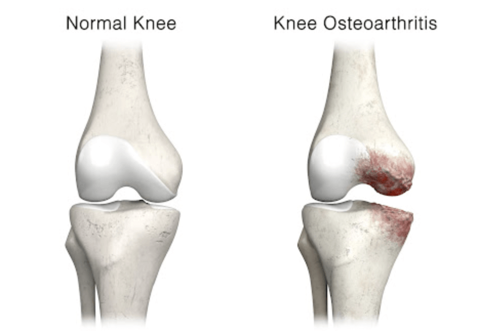 무릎 관절염 증상