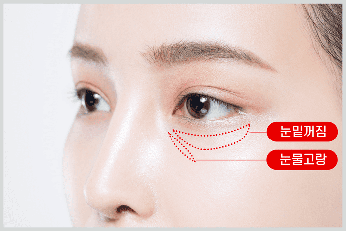 눈밑꺼짐, 눈밑주름 없애는 방법! 눈밑지방 없애는 마사지 TIP