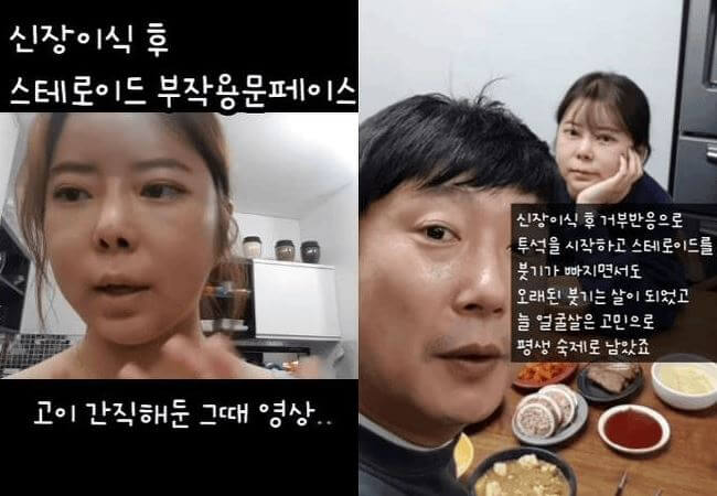 이수근 아내 부작용