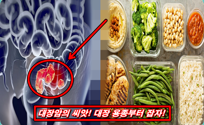 대장암
