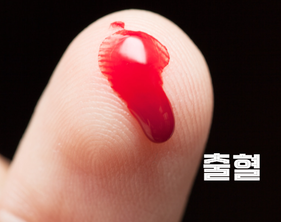 비타민 K 결핍 증상, 출혈 쉽게 듦