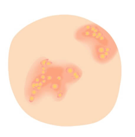 대상포진 초기증상 대상포진 조기치료 대상포진 초기증상 및 조기치료