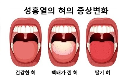 가장 흔한 증상은 '딸기혀'가 특징입니다