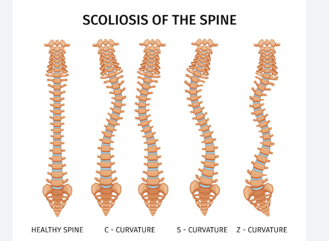 척추측만증에 대한 완전 정보와 관리 방법