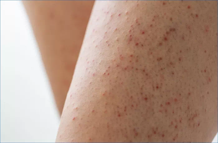 다리 모공각화증