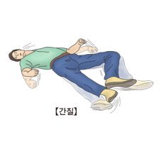 뇌전증