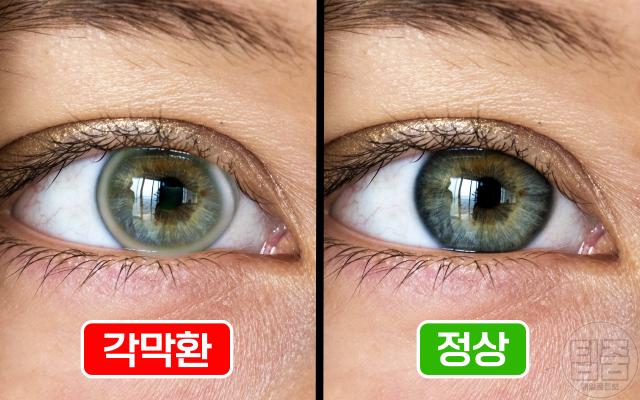 콜레스테롤 수치 높으면 혈관 생로병사의 비밀 눈동자 흰고리