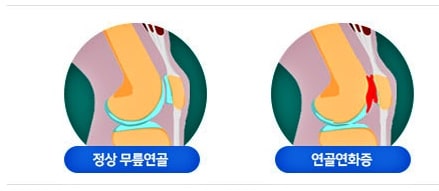 무릎에서-사각사각-소리-연골연화증