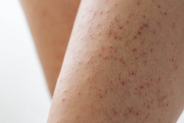 모공각화증 미스트 효과 있을까? 셀프 치료와 원인, 주요 증상들이 어떤 것들이 있는지 참고 하시기 바랍니다.