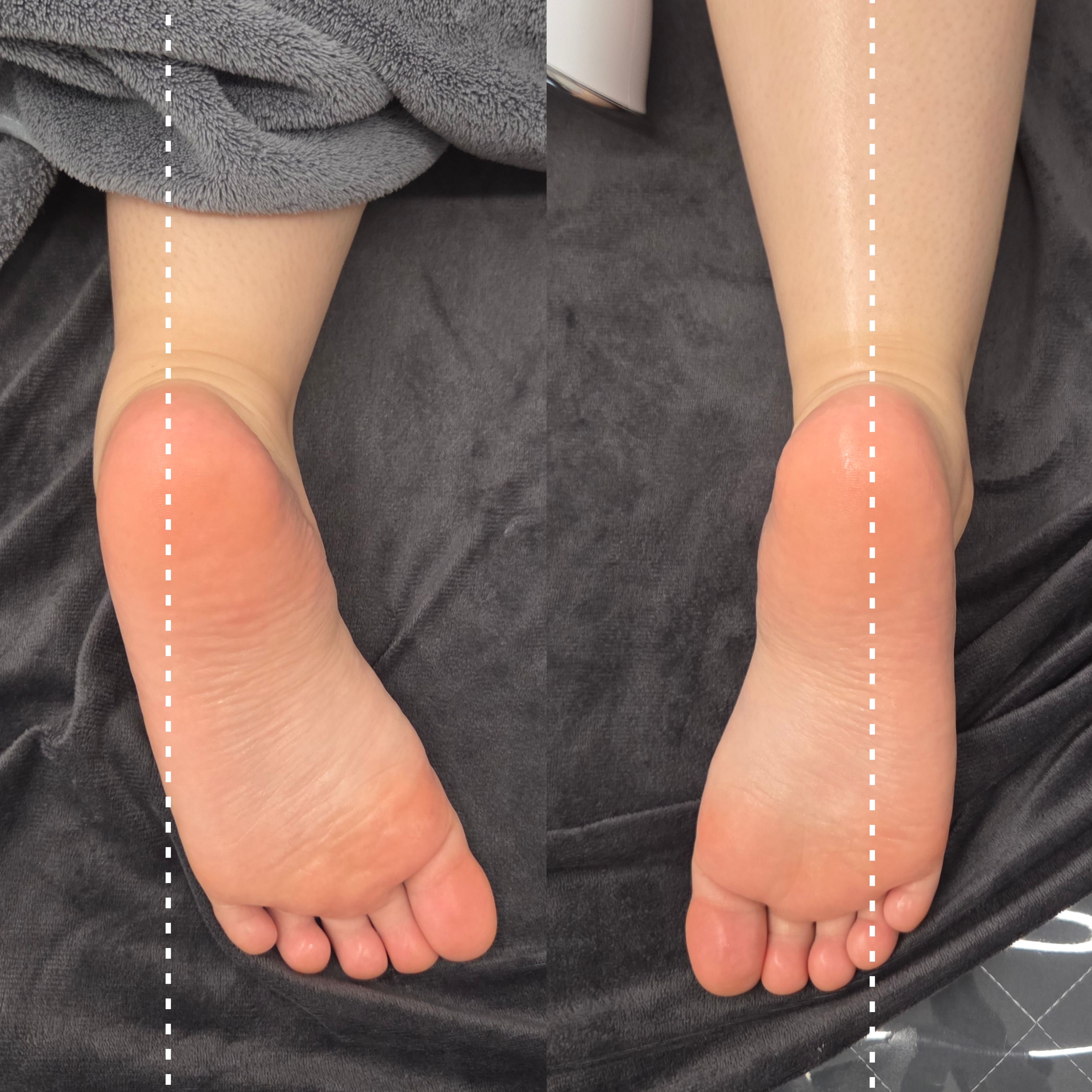 하체 에너지 테라피 관리 후 발목의 비대칭이 개선되고 아킬레스건이 곧게 정렬된 뒷모습