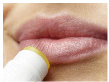 헤르페스 2형 성병 증상