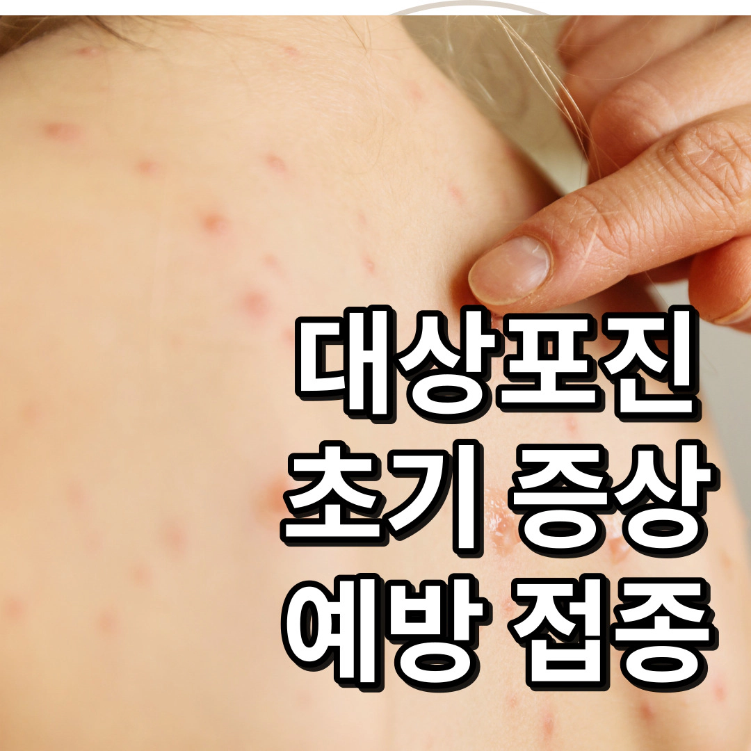대상포진-초기 증상-예방 접종