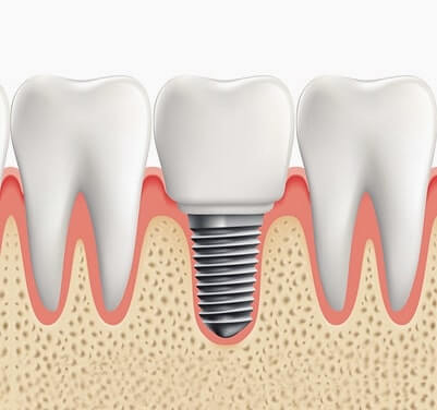 임플란트 시술과정4