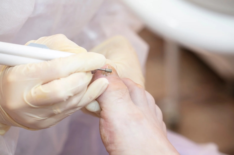 여름철 발톱무좀 퇴치법 사진