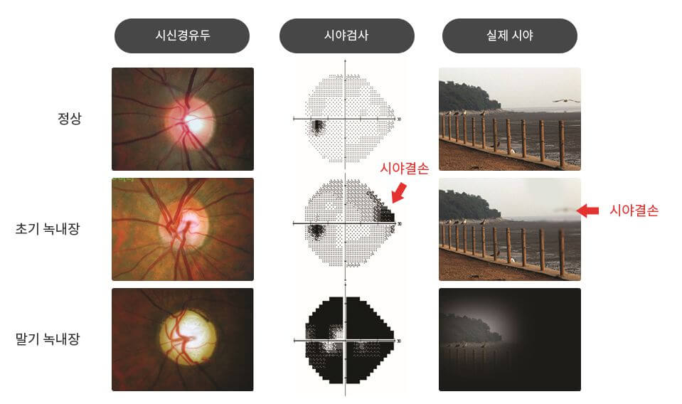 녹내장증상-시야