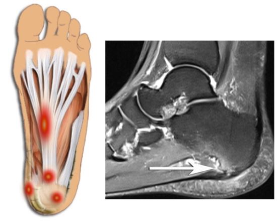 족저근막염 치료