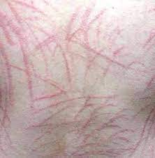 표고버섯 부작용인 표고버섯 피부염