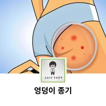 엉덩이 종기가 생기는 이유 왜 생기고 어떻게 관리할까요 완벽 가이드_16