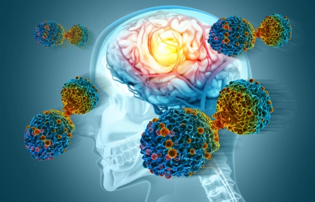 알츠하이머·파킨슨·혈관성 치매 차이점 총정리 + 증상 체크리스트