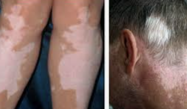 백반증 초기증상 9