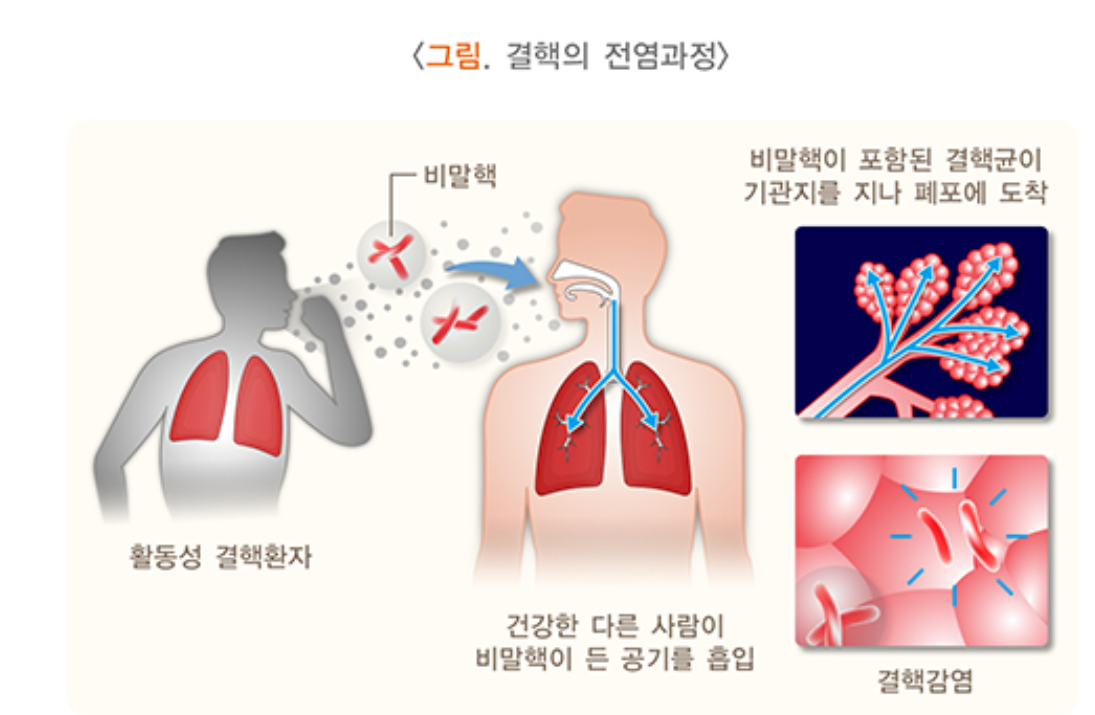 결핵이란