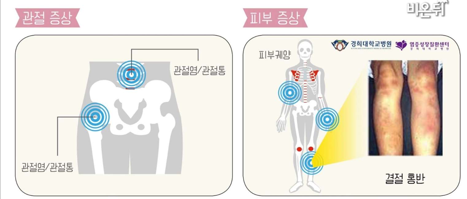 크론병 증상