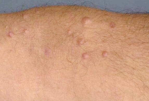 신경섬유종 사진