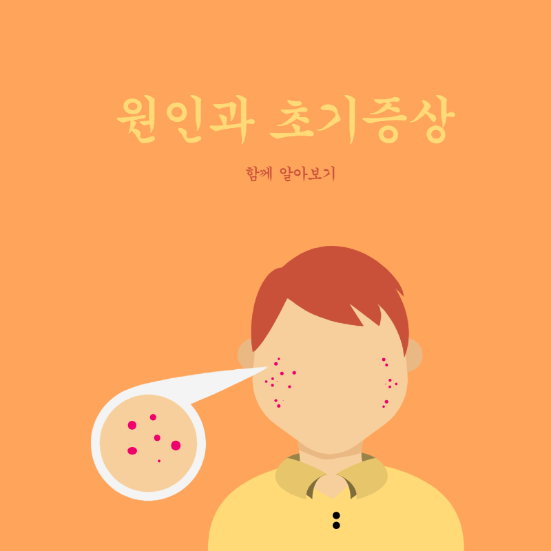 대상포진초기증상