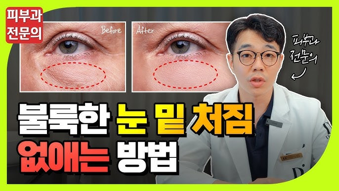 눈밑꺼짐- 없애는- 법-젊고생기있는