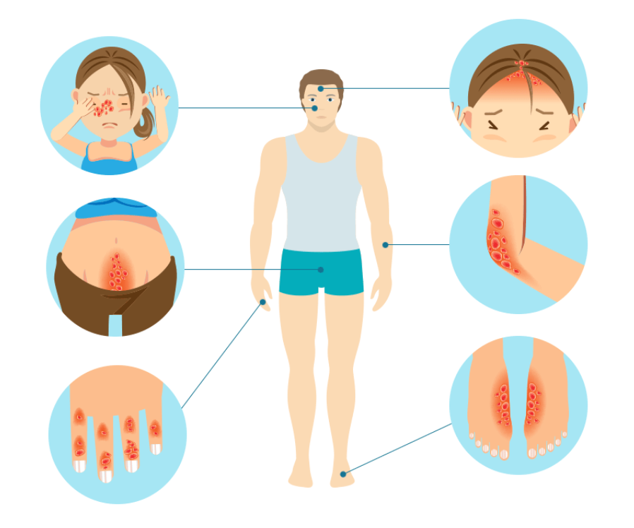 백선증 관련 이미지