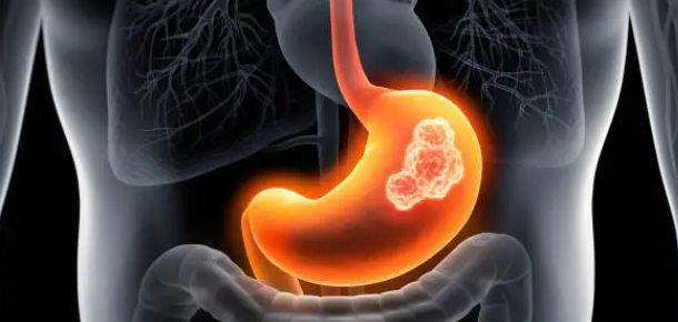 위암 관련 사진