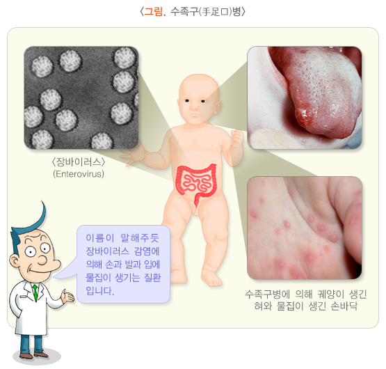수족구병