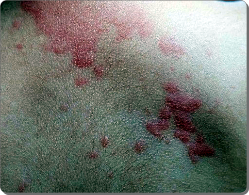 대상포진 초기증상 18