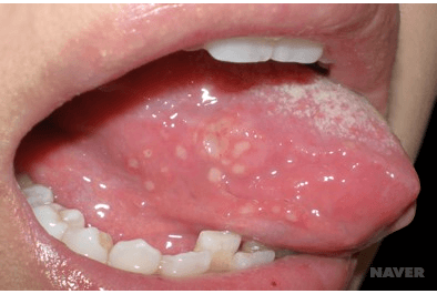 혓바늘 원인, 치료하는 방법