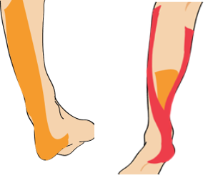 종아리 압박 테이핑