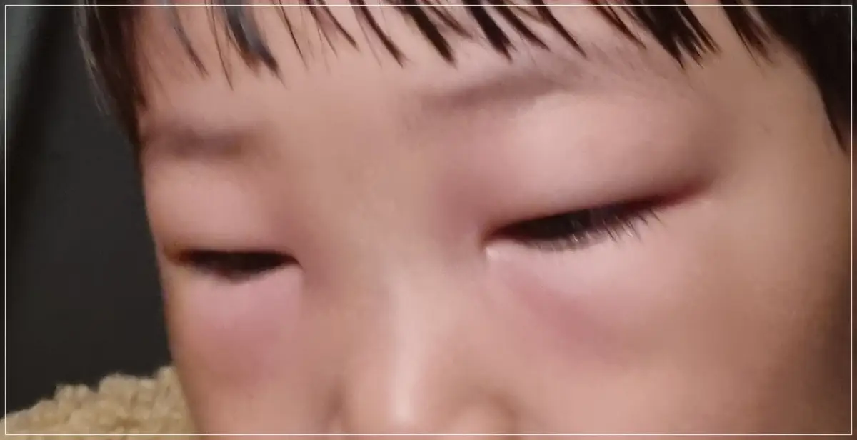 눈 두덩이 붓는 알레르기 증상 사진