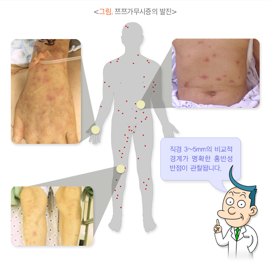 쯔쯔가무시증 발진