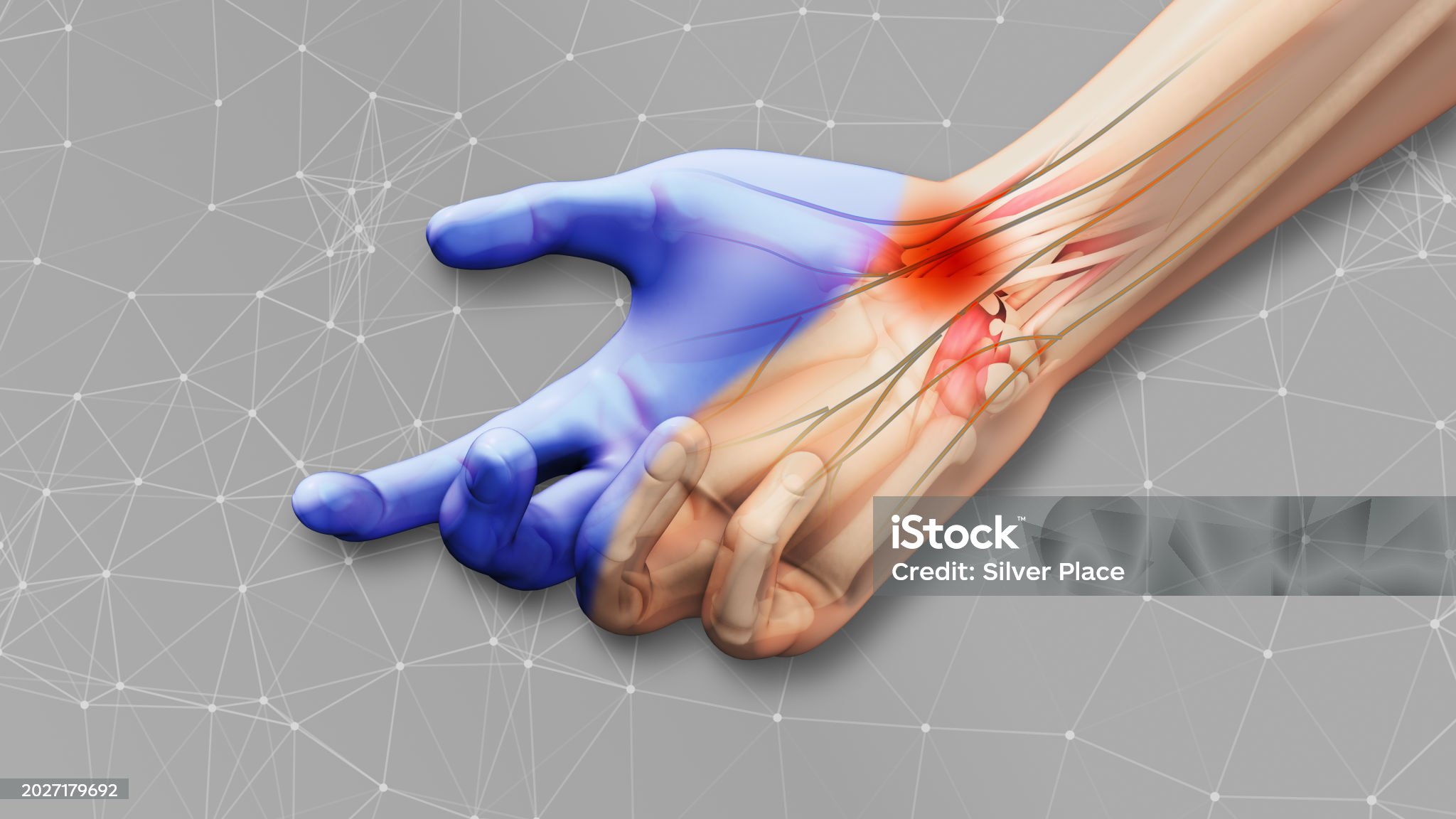 손목터널증후군-관련-사진