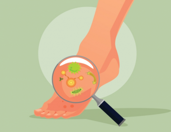 무좀 증상별 무좀약 추천