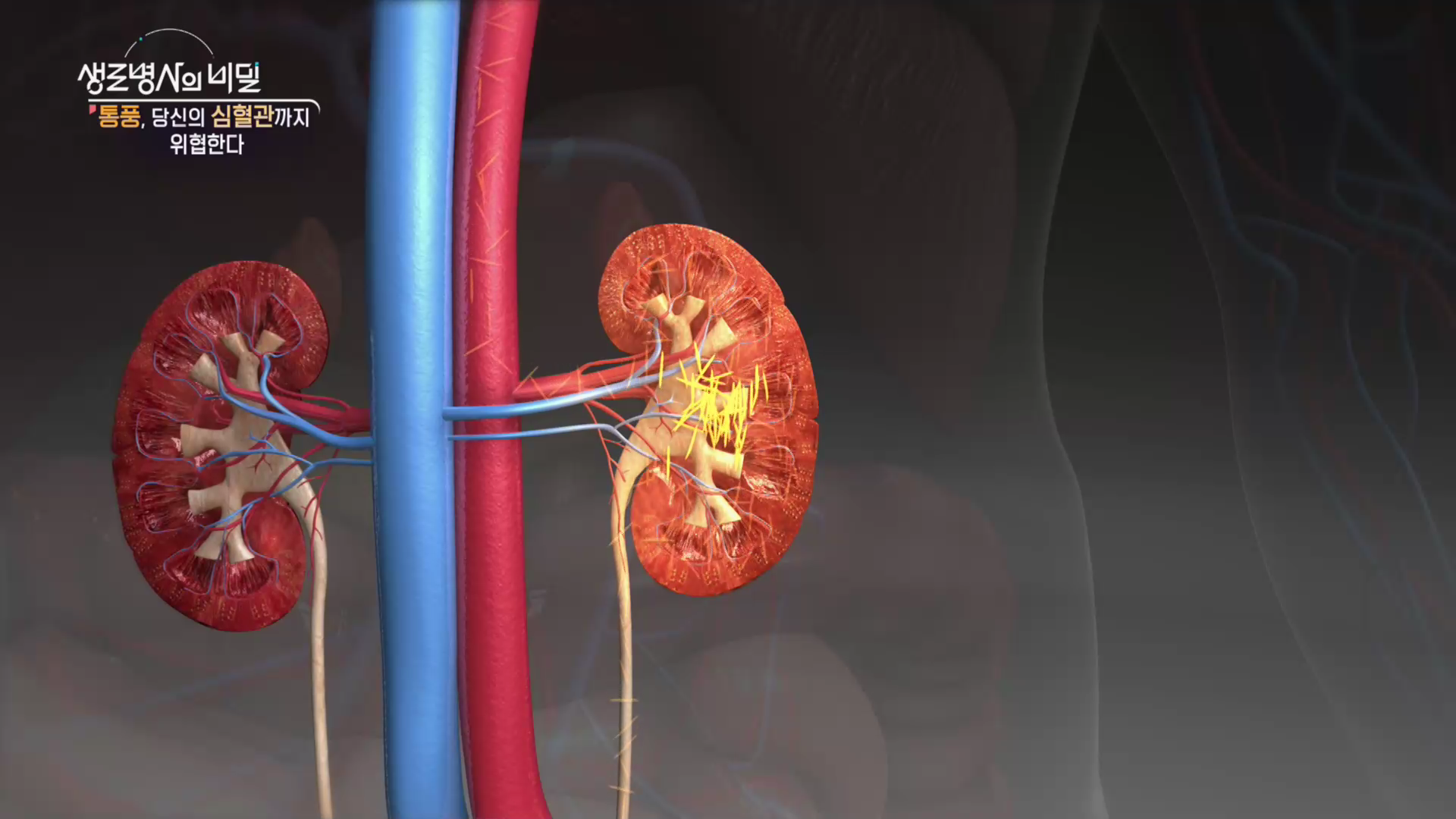 생로병사의 비밀 통풍