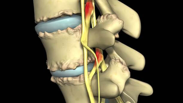 허리디스크 터지면 증상에 따라 수술여부를 판단하곤 합니다. 허리 디스크는 노화&amp;#44; 잘못된 자세&amp;#44; 반복적이고 과도한 움직임으로 인한 퇴행성 변화로 인해 발생합니다. 허리디스크가 터지면 수술을 해야 하는지 매우 고민스러운데요. 허리디스크 단계적인 증상과 치료 방법들을 알아봤습니다. 참고하시기 바랍니다.