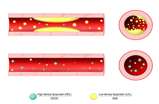 콜레스테롤의 종류