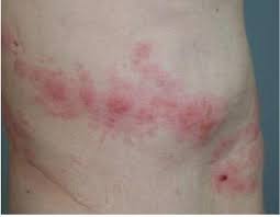 대상포진 초기증상 10가지