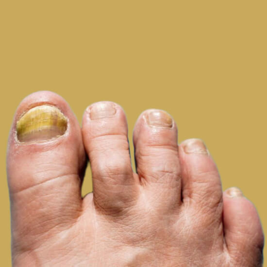 노란 발톱무좀 이유, 치료 방법
