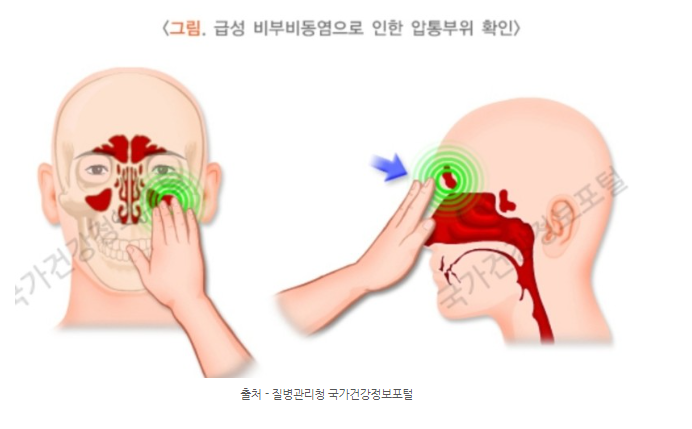 부비동염