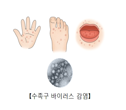 수족구 걸렸을 때 보험 청구 가능한 방법 총정리